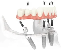 All on four implant