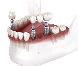 Dental implant supported bridge